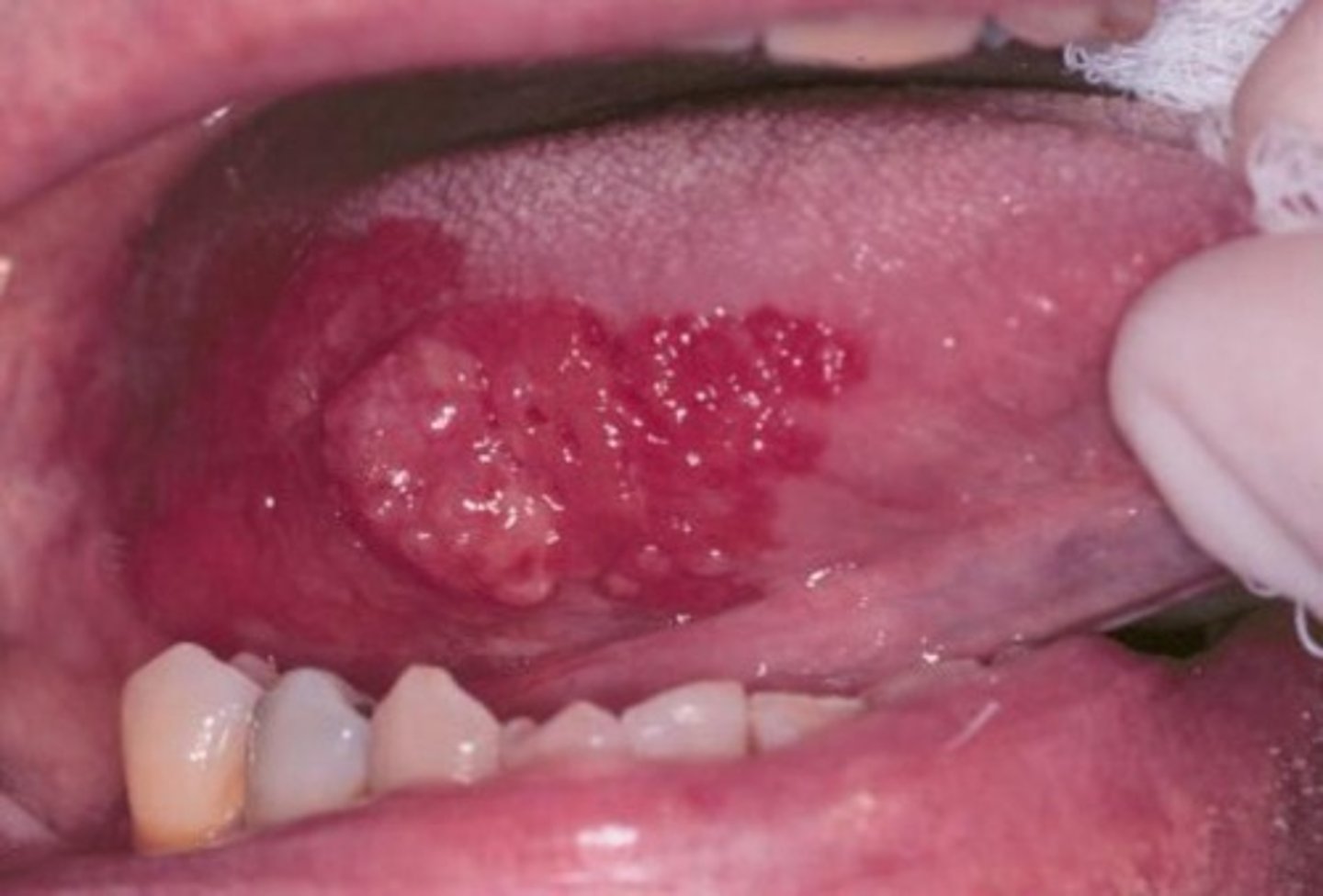 <p>Undetectable = Untransmittable. A person with an undetectable viral load due to successful ART cannot sexually transmit HIV to partners.</p>