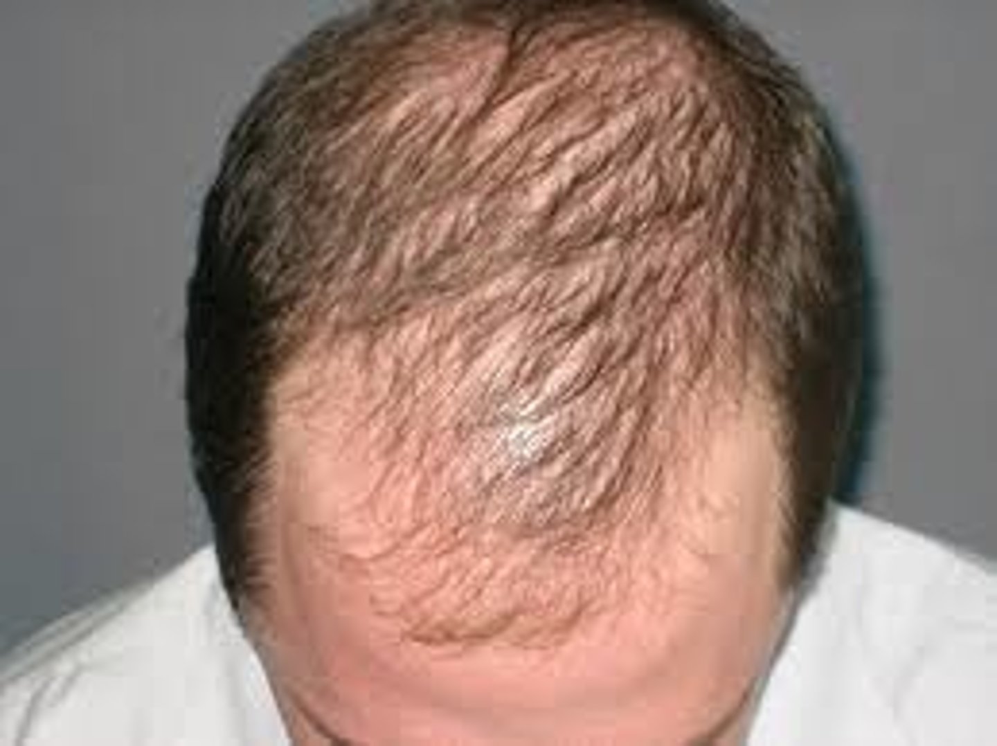 <p>diagnose this:</p><p>hair thinning on the crown and/or recession in temples</p>