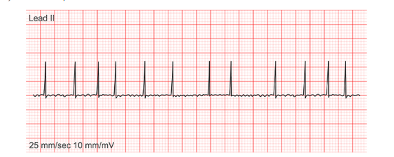 <p><span><span>Which rhythm is on the strip?</span></span></p>