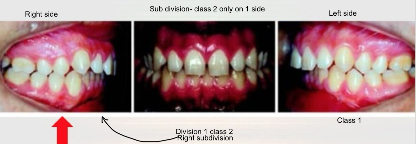 <p>When class 2 molar relationship exists on <strong>only one side</strong>, normal relationship on other </p>