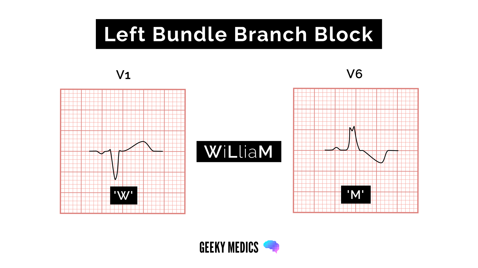 <p>In patients with new or <strong>presumably new LBBB and symptoms suggestive of ACS</strong>, it is treated <strong>as a STEMI equivalent because it can mask typical ST-elevations</strong> due to underlying <strong>ventricular depolarization abnormalities.</strong></p><p></p><p><strong>Left Bundle Branch Block (LBBB):</strong></p><p>LBBB is a cardiac conduction abnormality where the electrical impulse is delayed or blocked in the left bundle branch. This results in widened QRS complexes on ECG. It can indicate heart disease.</p><p></p><p><span>To recognise left bundle branch block, we use the name WiLLiaM and look at the first and last letters: </span><strong>W: complexes in V1 resemble the letter W: deep downward deflection (dominant S wave), which may be notched</strong><span>. </span><strong>M: complexes in V6 resemble the letter M: broad, notched or 'M' shaped R wave in V6</strong></p>