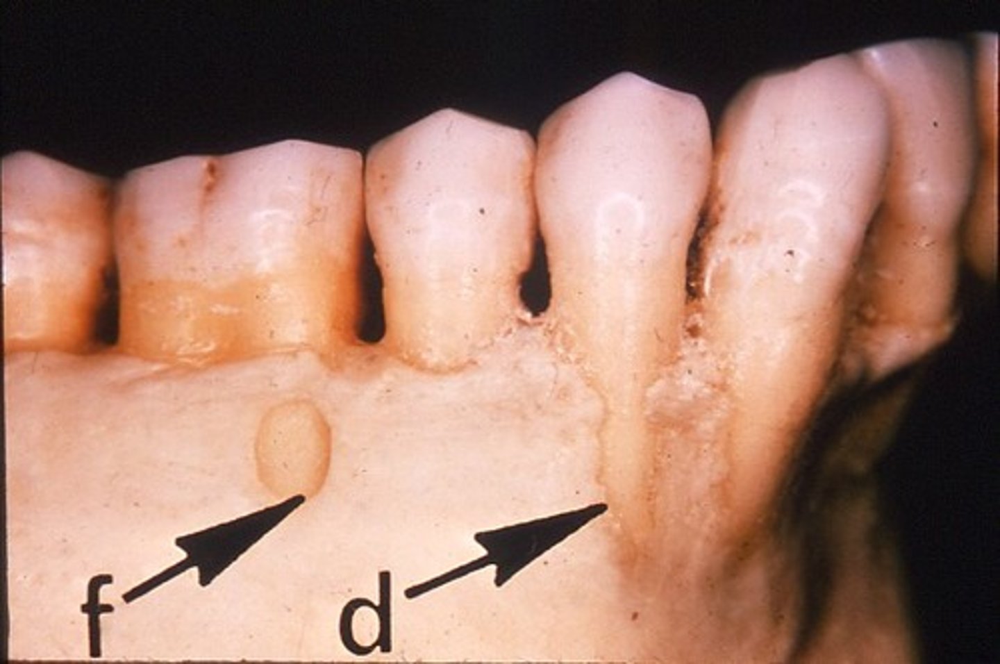 <p>a window-like opening in the bone covering the root of a tooth bordered by alveolar bone on the coronal aspect of the tooth.</p>