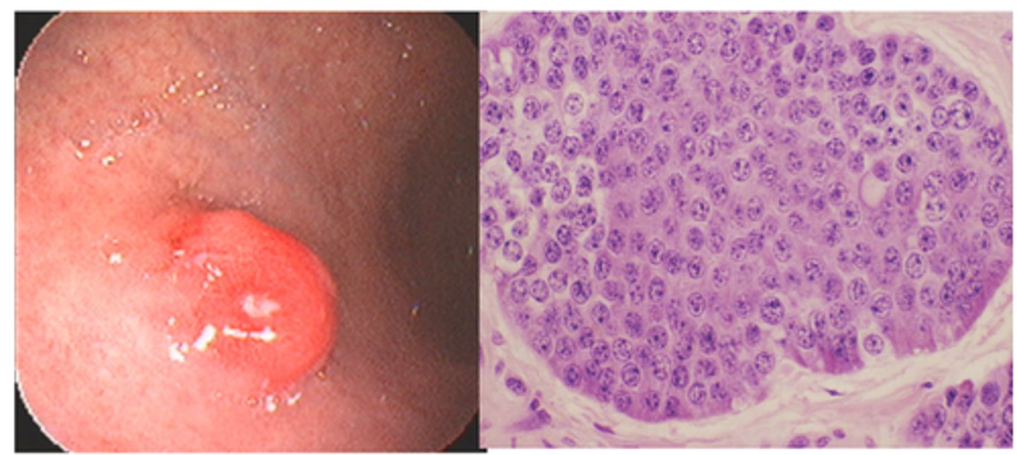 <p>B) Gastrin</p><p>Gastric neuroendocrine tumor</p>