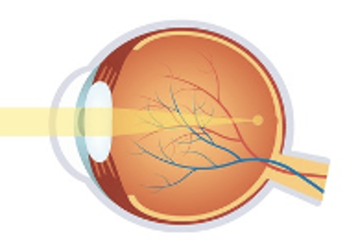 <p>-Reduced vision at distance</p><p>-Good vision at near</p>