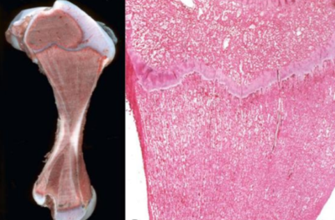 <p>Patho ostéopétrose (Os de marbre)</p>