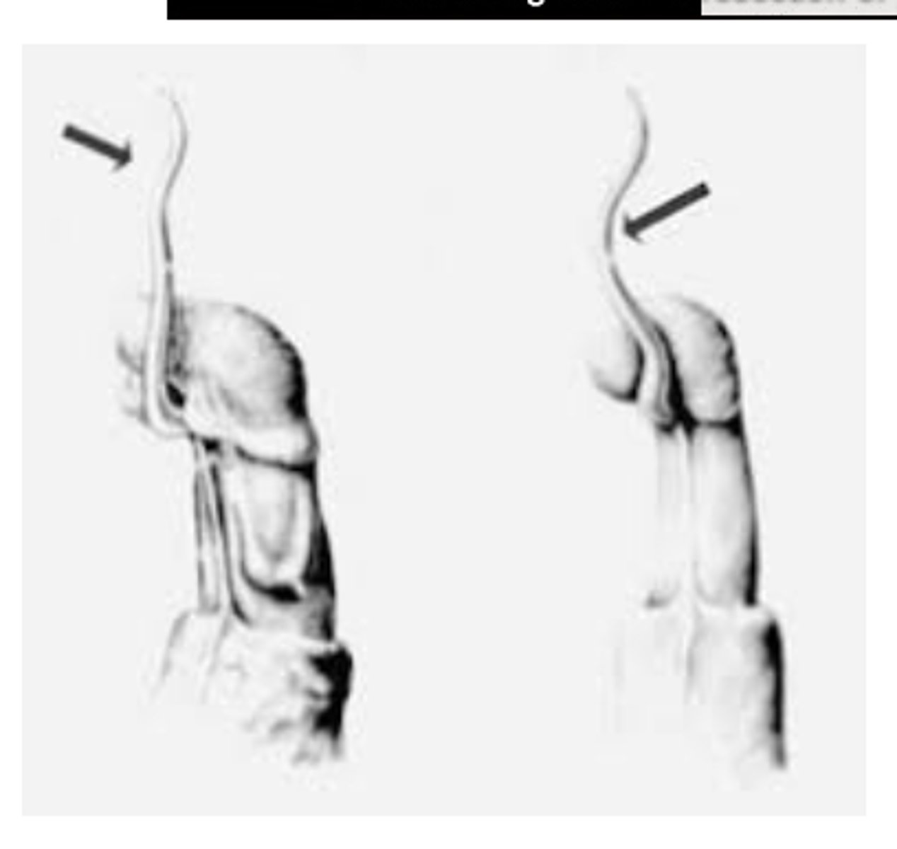 <p>urethral process/vermiform appendage (common place for urolithiasis)</p>