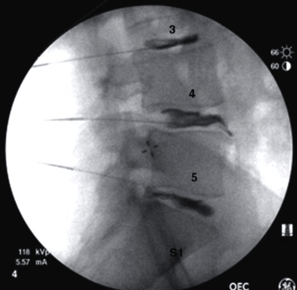 <p>What type of imaging study is this?</p><p>a. PET scan</p><p>b. Bone Scan</p><p>c. T1 MRI</p><p>d. Fluoroscopy</p>