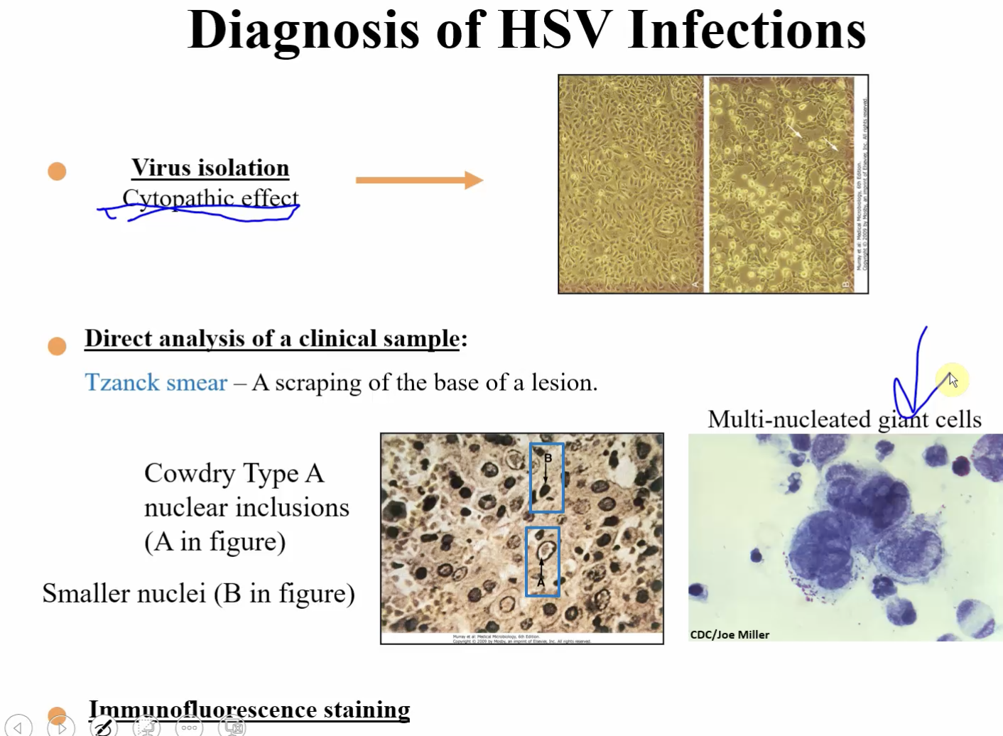 <p><u>Virus Isolation</u>:</p><ul><li><p>Cytopathic Effect</p></li></ul><p><u>Direct analysis of clinical sample</u>:</p><ul><li><p><span style="color: #f6d3ff"><strong>Tznack Smear</strong></span> - a scraping of the base of a lesion</p><ul><li><p>Cowdry Type A nuclear inclusions</p></li></ul></li></ul><p><u>Immunofluorescence Staining</u></p><p></p>
