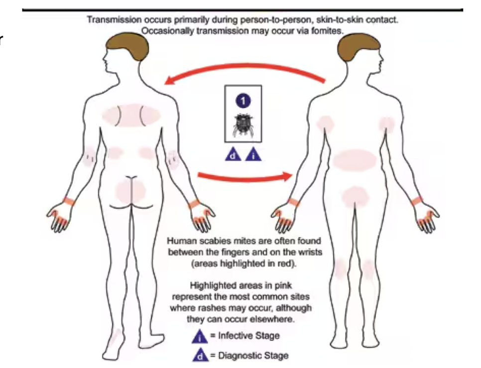 <p>Which parasites are transmitted by <strong>direct contact with fomites</strong> and cause <strong>scabies?</strong></p><ul><li><p> intensely <strong>pruritic</strong> <strong>papular</strong> <strong>rash</strong> with <strong>possible</strong> <strong>burrows</strong></p><ul><li><p>usually not on head</p></li></ul></li><li><p>crowded conditions increase risk</p></li></ul>