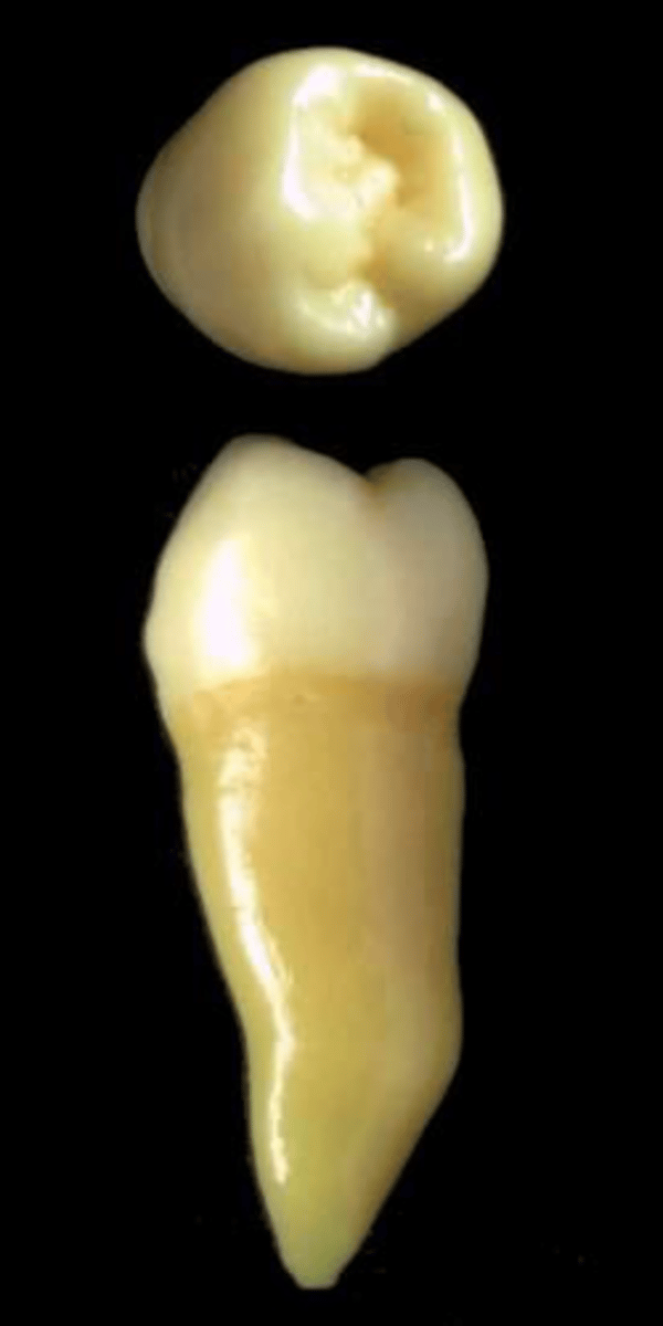 <p>what tooth is this &amp; why?</p>