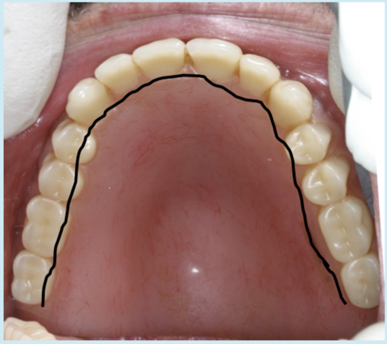 <p>Surface of the upper teeth that is next to the hard palate.</p>