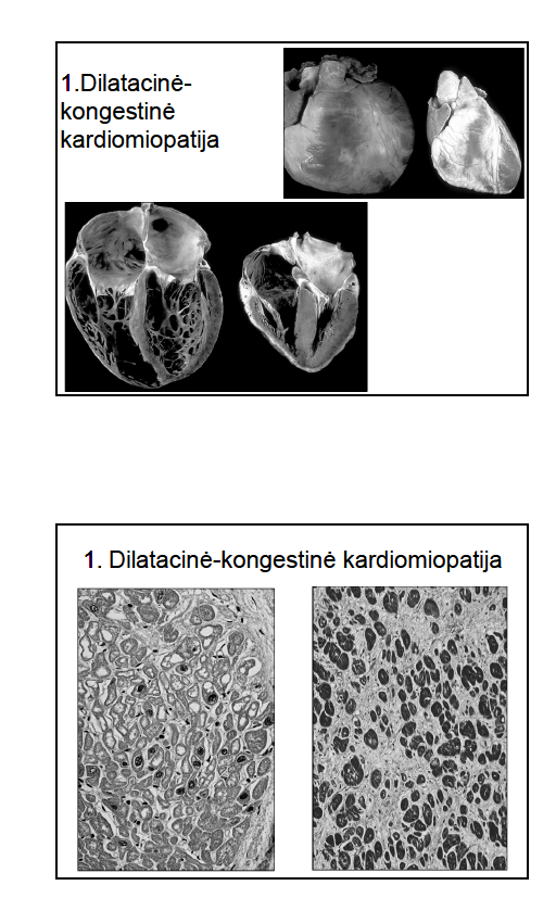 <p>aortos ir dviburį vožtuvus (4:1 vyrams, 2:1 moterims)</p><p>Narkomanams pažeidžiamas dažniausiai triburis vožtuvas</p><p><strong>Dažniausia pažeidžiami kairiojo skilvelio vožtuvai</strong></p>