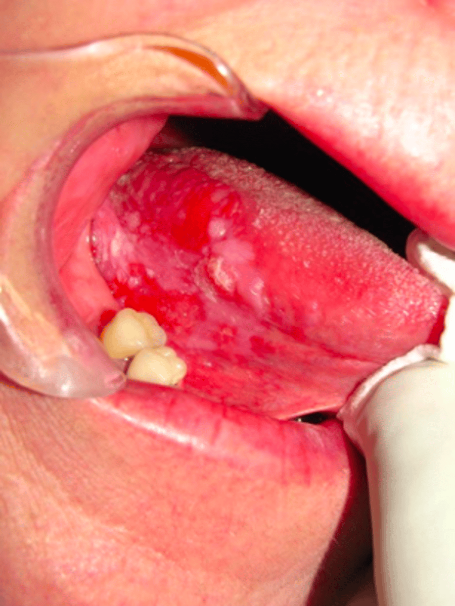 <p>a patient presents with a non-healing leukoerythroplakic ulcerated lesion on the ventral latereral border of the tongue. The lesion has been there for 3 weeks. What type of biopsy should you take?</p><p>- Aspiration</p><p>- Cytology</p><p>- Incisional</p><p>- Excisional</p>