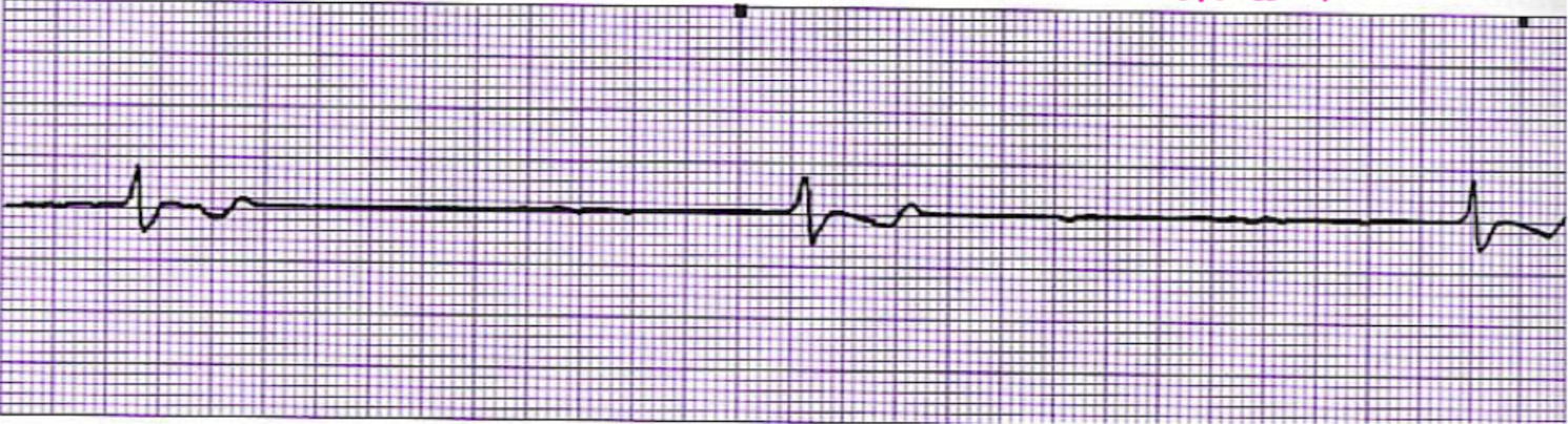 <p>What is this rhythm?</p>