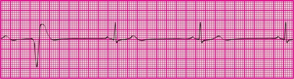 <p> Less than 6 PVCs per minute</p>