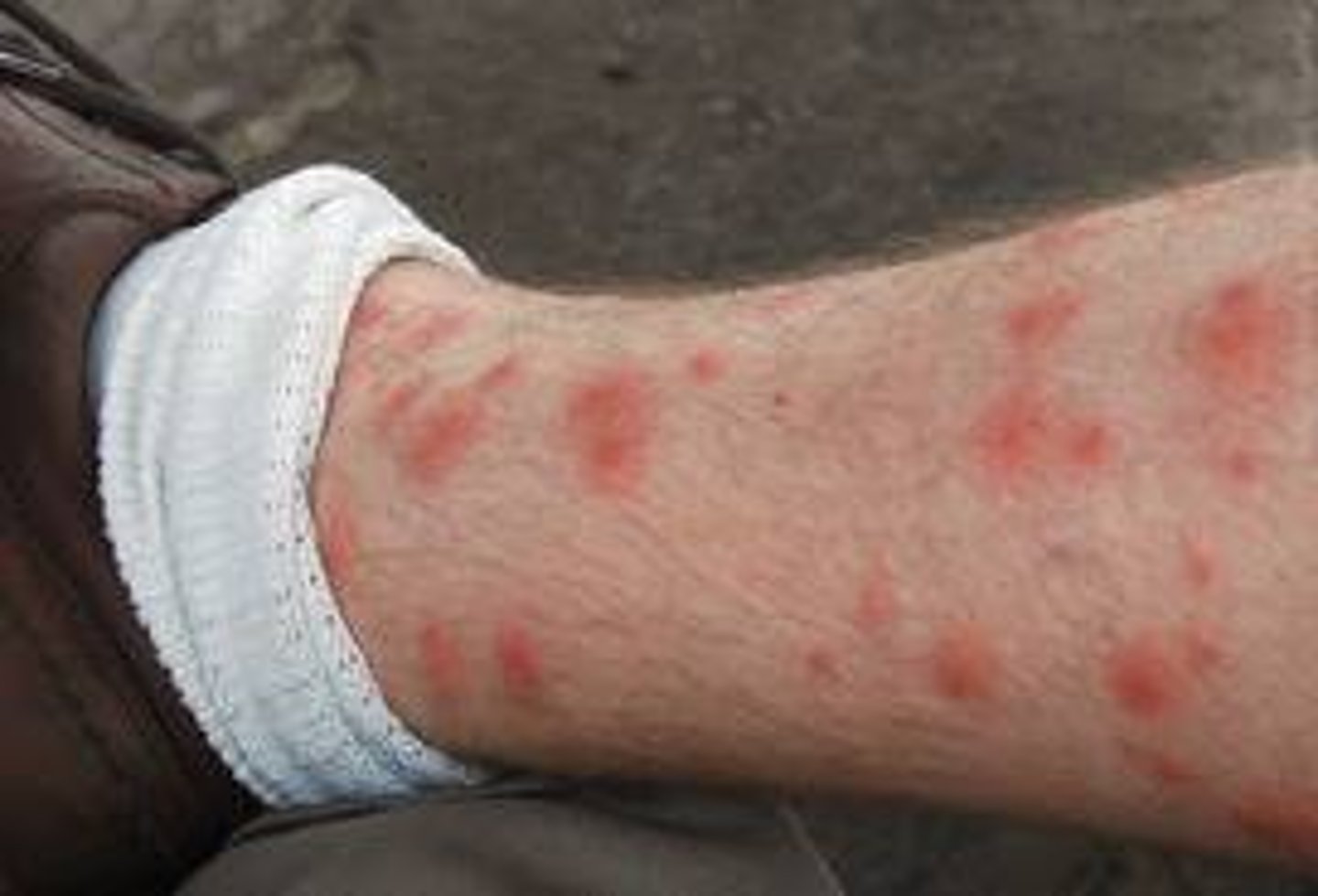 <p>diagnose this:</p><p>Intense itching around sock line or pant waist</p><p>Not a widespread rash</p>