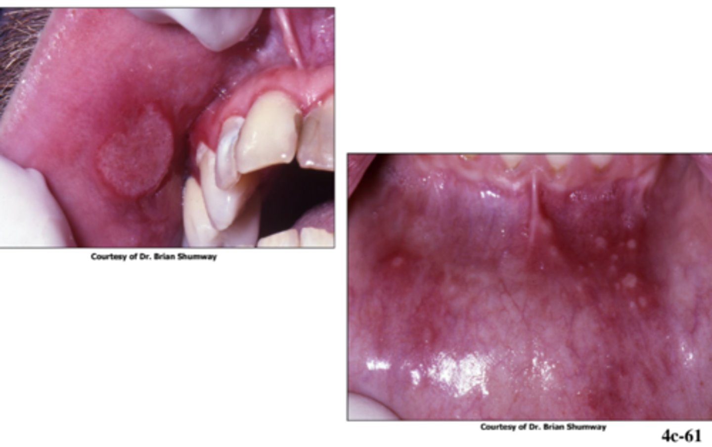 <p>immune</p><p>- single or multiple lesions / painful &amp; persistent</p><p>- topical corticosteroids</p>