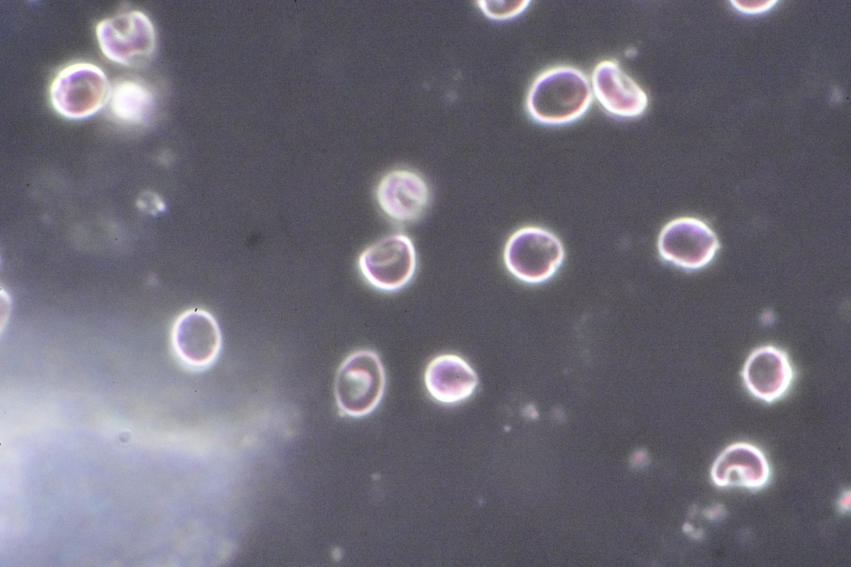 A microscopic test of fluid taken from a lesion in suspected primary syphilis (a bacterial infection usually spread by sexual contact) 

The syphilis organism appears bright against a dark background 