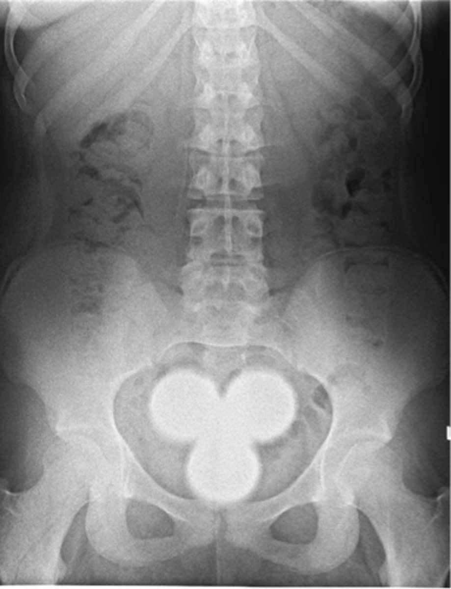 <p>- A disc herniation that goes through the vertebral endplate into the medullary aspect of the disc</p><p>- MC at the thoracolumbar junction</p>