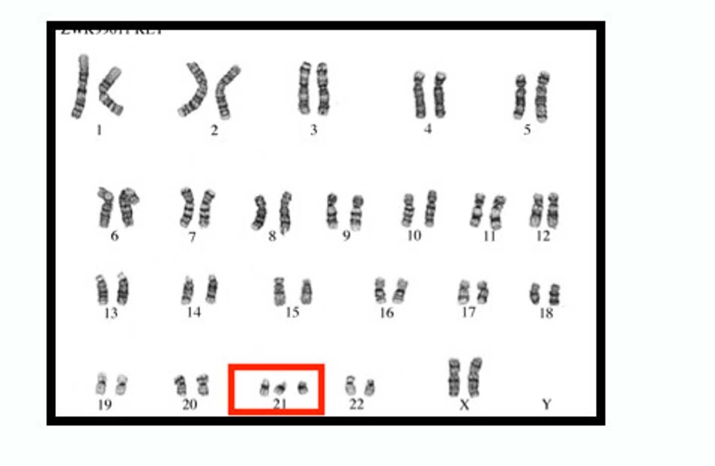 <p>An extra copy of chromosome 21</p>