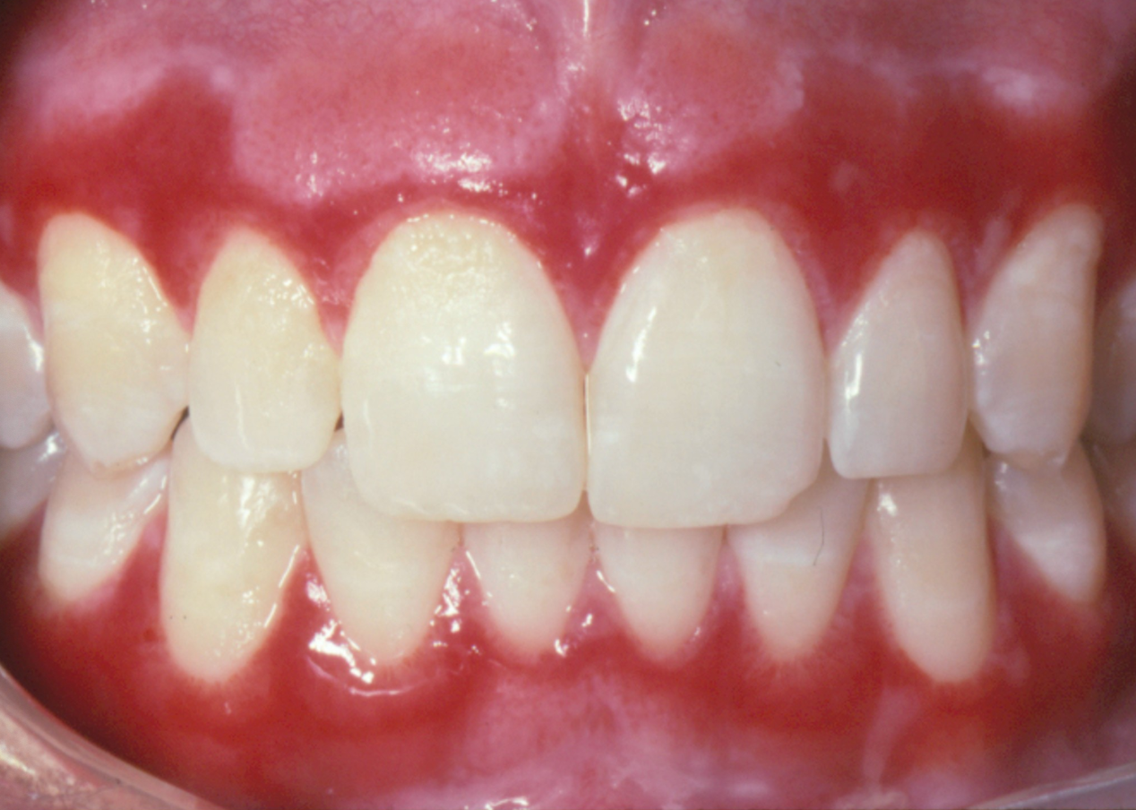 <p>3f. Which medication should also be prescribed with corticosteroids in this case?</p><p><span><span>Mycelex troches</span></span></p><p><span><span>Prednisone tablets</span></span></p><p><span><span>Nystatin mouth rinse </span></span></p><p><span><span>Acyclovir tablets</span></span></p>