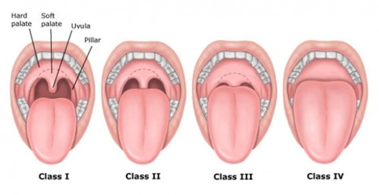 <p>mallampati classification</p>