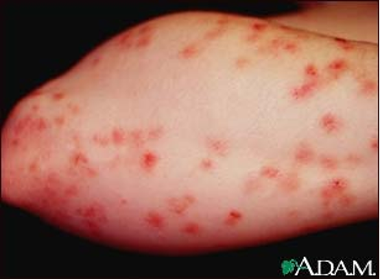 <p>Dermatitis Herpetiformis </p>