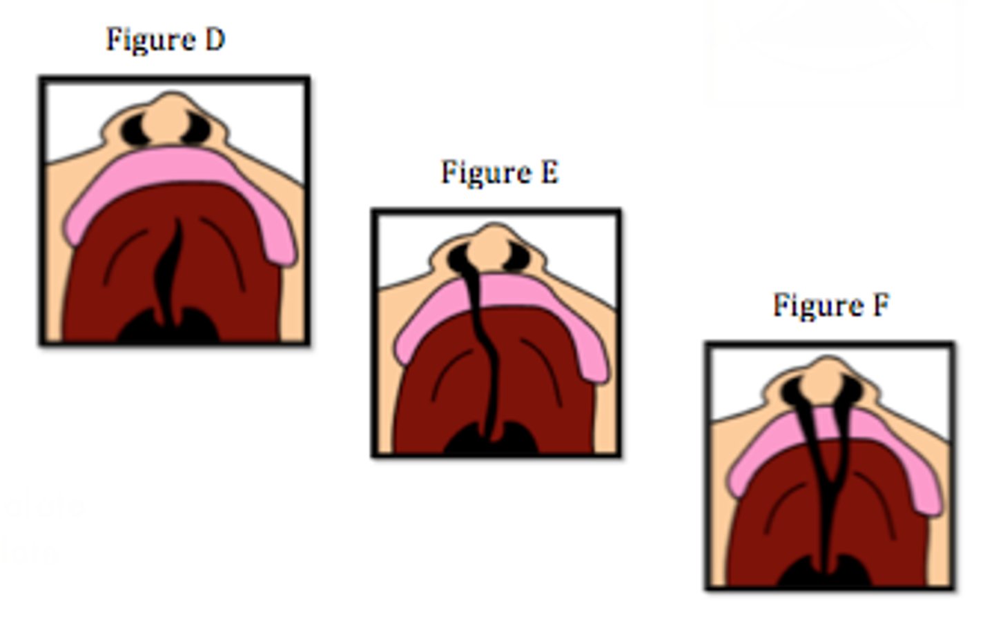 <p>Define Condition:</p><p>Abnormal gap at roof of mouth</p><p>-Hx: Present at birth</p><p>-Path: When the primary palate (from intermaxillary process) &amp; secondary palate (midline fusion of lateral palatine shelves from maxillary prominences) do not fuse normally by 8-12 weeks gestation</p><p>-Sx/PE:</p><p>&gt; May be unilateral or bilateral</p><p>&gt; May be complete (across whole palate) or incomplete (only part way across palate)</p><p>-Dx:</p><p>&gt; Detected on first newborn PE after inserting finger into newborn's mouth (less on prenatal ultrasounds)</p><p>-Tx: SURGERY</p><p>&gt; Cut and rearrange tissue around cleft to close opening</p><p>-Prog:</p><p>&gt; Prevents from feeding (can't suction)</p><p>&gt; Abnormal speech sounds</p><p>&gt; Recurrent middle ear infex and effusions ==&gt; HEARING LOSS</p>