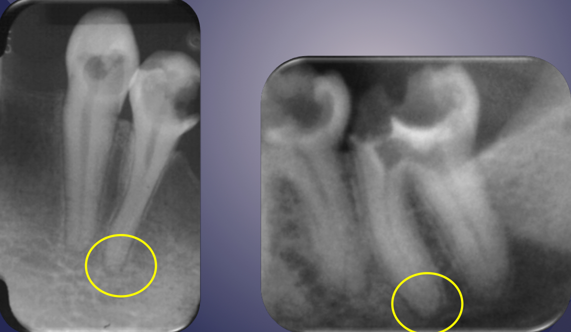 <p>lack of continuous lamina dura, initial sign </p>