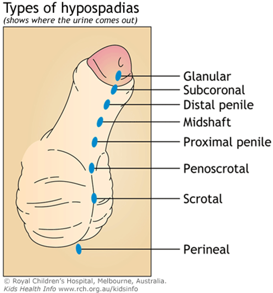 <p>hypospadias ***→ birth defect of abnormally placed urinary meatus</p>