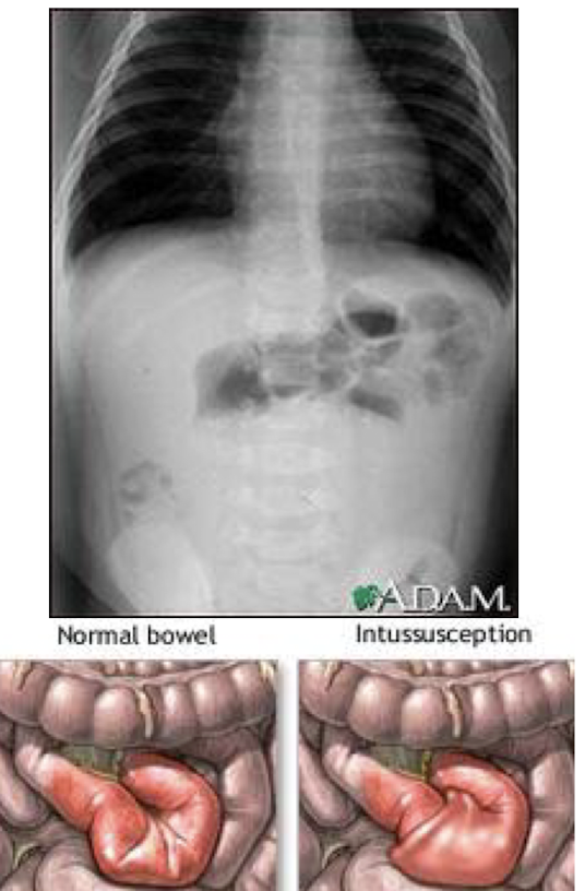 <p>A condition where a part of the intestine telescopes into an adjacent segment, causing obstruction and potential ischemia. </p>