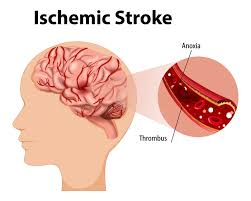 <p><strong>A 20-year-old has been admitted to a rehabilitation center after hospital treatment for an</strong></p><p><strong>ischemic stroke. Which of the following aspects of the client's history would be</strong></p><p><strong>considered to have contributed to his stroke? Select all that apply. The client</strong></p><p>A) is an African American male.</p><p>B) takes iron supplements for the treatment of chronic anemia.</p><p>C) blood pressure has historically been in the range of 150s/90s.</p><p>D) was diagnosed with type 2 diabetes 8 years ago.</p><p>E) takes corticosteroids for the treatment of rheumatoid arthritis.</p>
