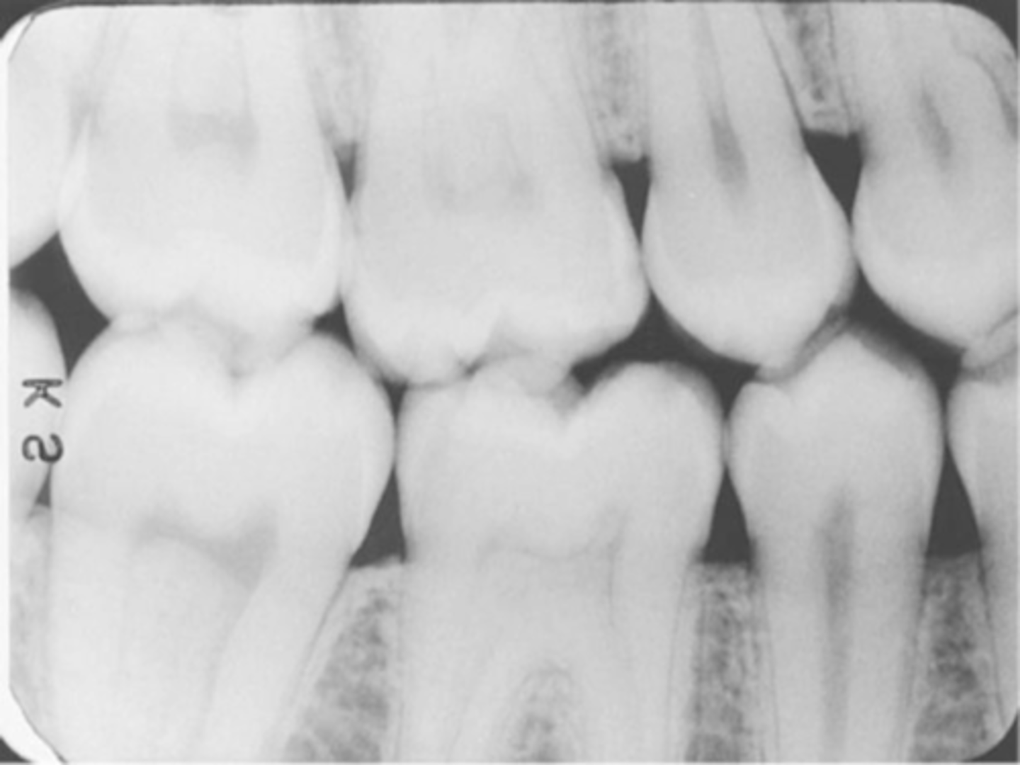 <p>-Third molar regions are not visible</p><p>-Receptor was too far anteriorly in the mouth; front edge of the receptor was not placed at the midline of the mand. 2nd premolar</p><p>-To prevent Always center on the mand. 2nd molar, even with 3rd molars are not present</p>