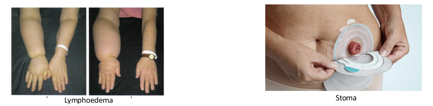 <p>Best method to achieve cure if tumor is localized</p><p>Side Effects</p><ul><li><p>Lymphoedema: after breast surgery where excision of lymphatic vessel in axilla lead to accumlation of lymph in arm</p></li><li><p>Stoma: after bowel surgery where end of resected bowel is externalized at abdomen to allow drainage of fecal content into a stoma bag</p></li></ul><p></p>