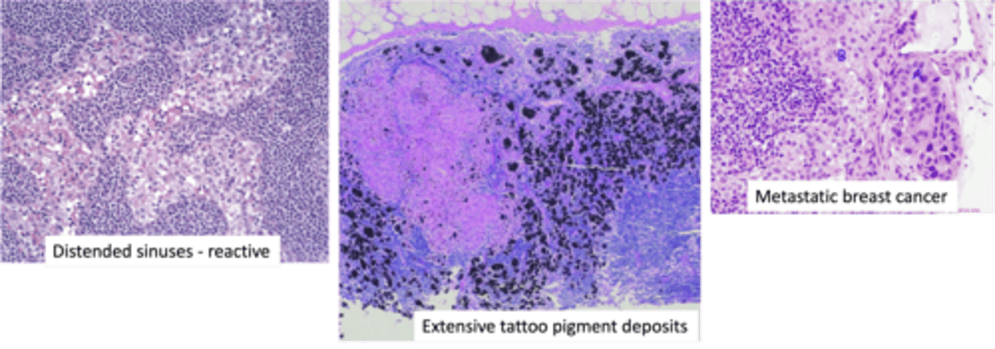 <p><span style="text-decoration:underline">ID Condition</span>:</p><p><strong><em><span class="bgY">Distention and Prominence of Lymphatic Sinusoids</span> (d/t marked hypertrophy of lining endothelial cells &amp; macrophage infiltrate)</em></strong></p><p>-<span style="text-decoration:underline">Hx</span>:</p><p>&gt; LNs draining cancers</p><p>&gt; Immune Response to Tumor or Tumor Products</p><p>&gt; Response to <strong>TATTOO PIGMENTS</strong></p>