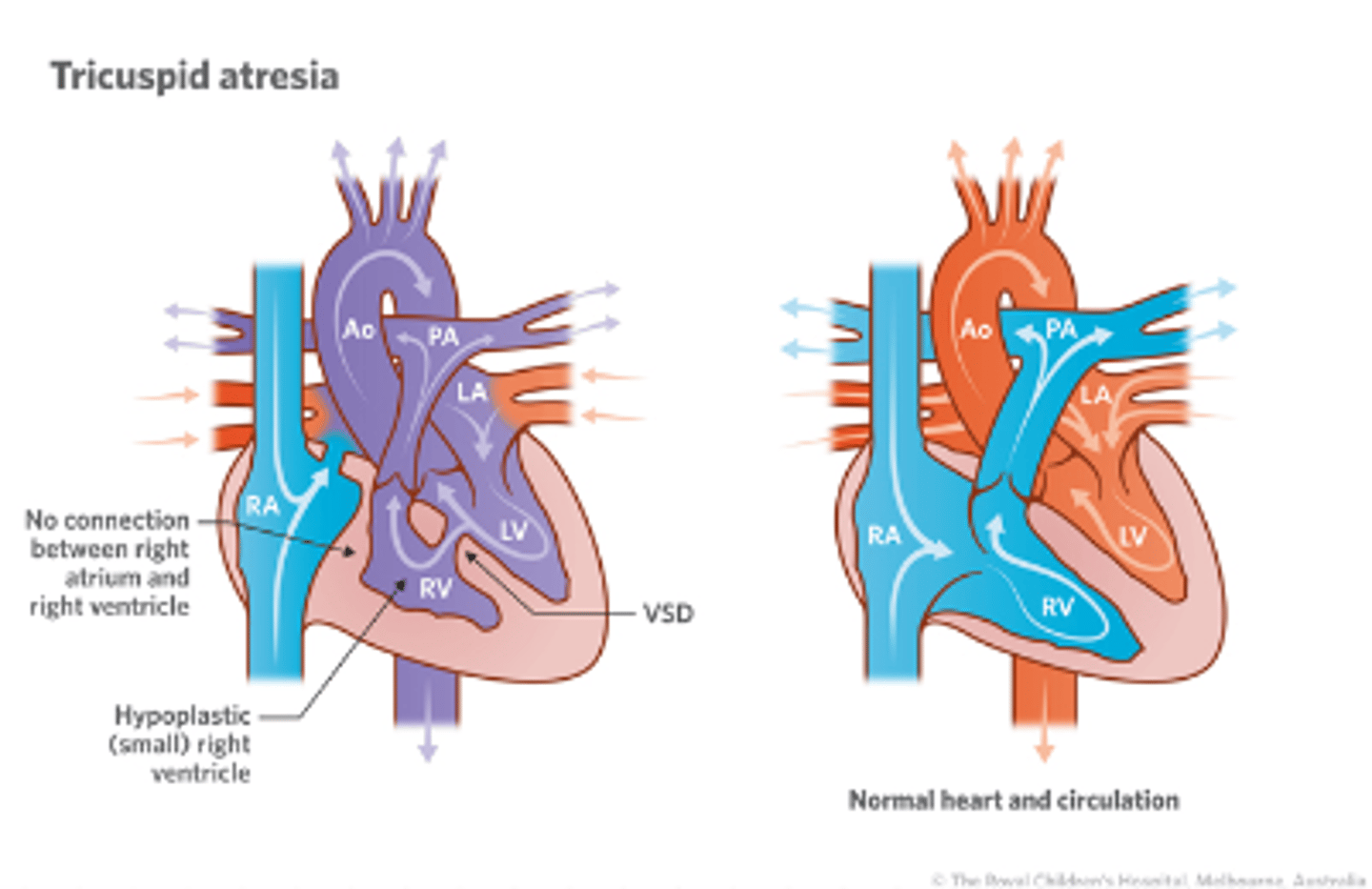 <p>- Is a birth defect of the tricuspid valve, which is the valve that controls blood flow from the right atrium (upper right chamber of the heart) to the right ventral (lower right chamber of the heart.)</p><p>- Occurs when the tricuspid valve doesn’t form at all , and no blood can go from the right atrium through the right ventricle to the lungs for oxygen.</p><p>- Blood will flow from the heart's right upper chamber directly to the left upper chamber through a hole in the wall between them. (PFO/ASD)</p>