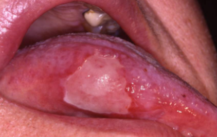 <p>occurs after radiation therapy </p>