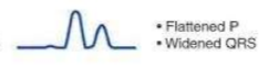 <p>What electrolyte disturbance would cause the ECG shown?</p>