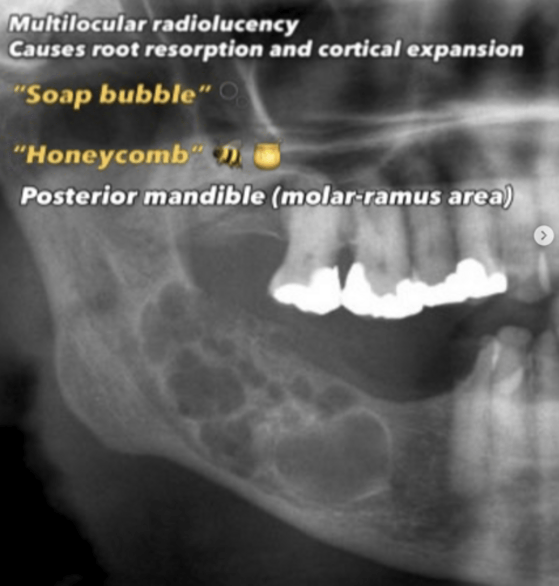 <p>- soap bubble appearance</p><p>- multilocular radiolucency</p><p>- root resorption</p><p>- jaw expansion</p>