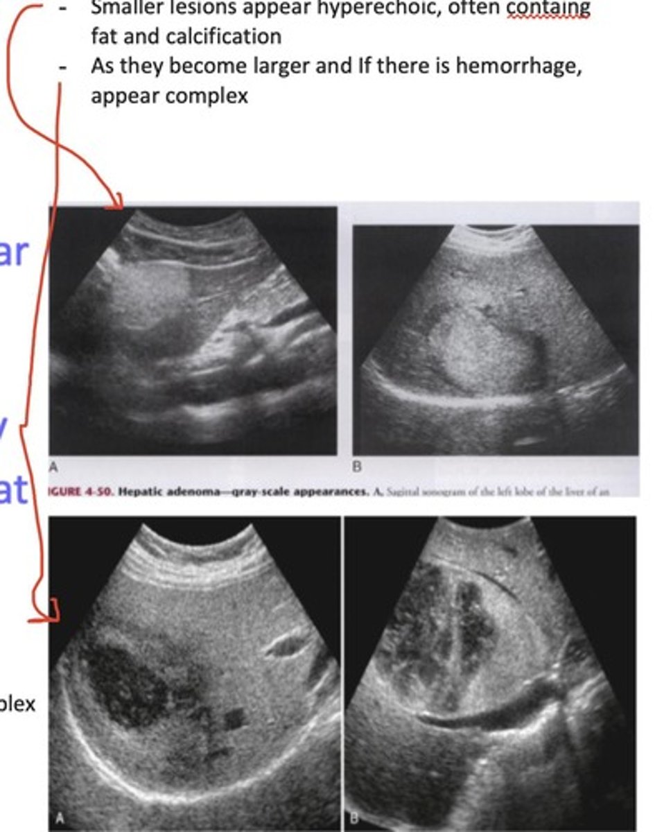 <p>SF: solitary, solid, vascular</p><p>- inc size = complex</p>