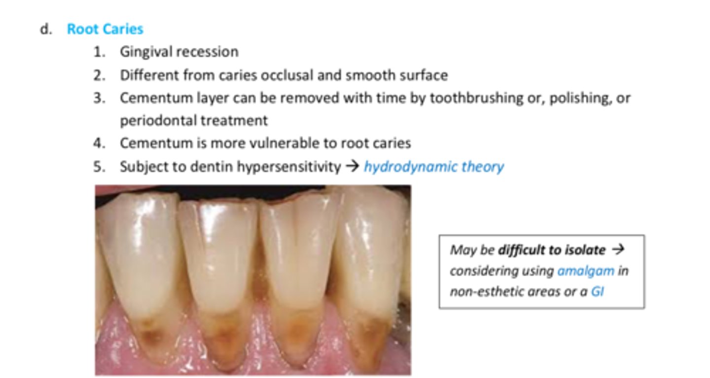 <p>Root caries</p>
