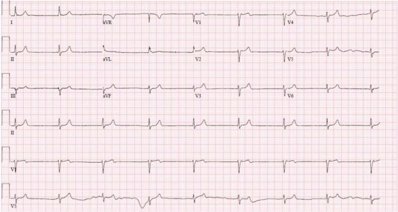 <p>What does this refer “Originating near the AV node, absent or inverted P waves”</p>