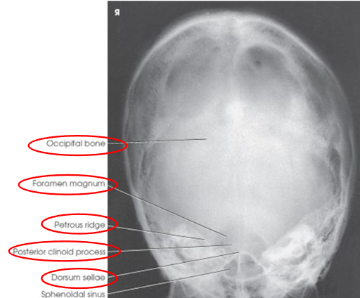<ul><li><p>projection of dorsum sellae and posterior clinoid processes within foramen magnum</p></li><li><p>equal distance from lateral border of skull and lateral margin of foramen magnum</p></li><li><p>symmetric petrous pyramids</p></li><li><p>entire cranium</p></li></ul><p></p>