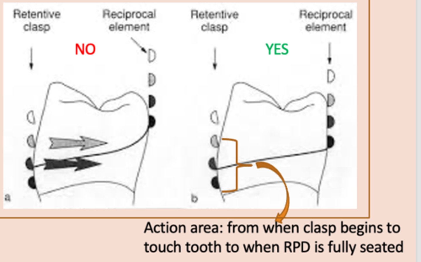 <p>Clasp Assembly six requirements:</p><p>4) – the active form of bracing, resists transient horizontal forces on the tooth from the retentive clasp when a partial denture is being seated and unseated in the mouth. This clasp must begin to contact the tooth at the same time as the retentive clasp throughout the entire action area so that this horizontal force is counteracted, so the lingual contour of the tooth should be flattened or a crown with a milled lingual ledge should be planned.</p>