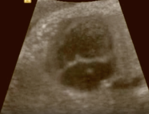 <p>a) turner syndrome</p><p>b) trisomy 13</p><p>c) trisomy 18</p><p>d) trisomy 21</p>