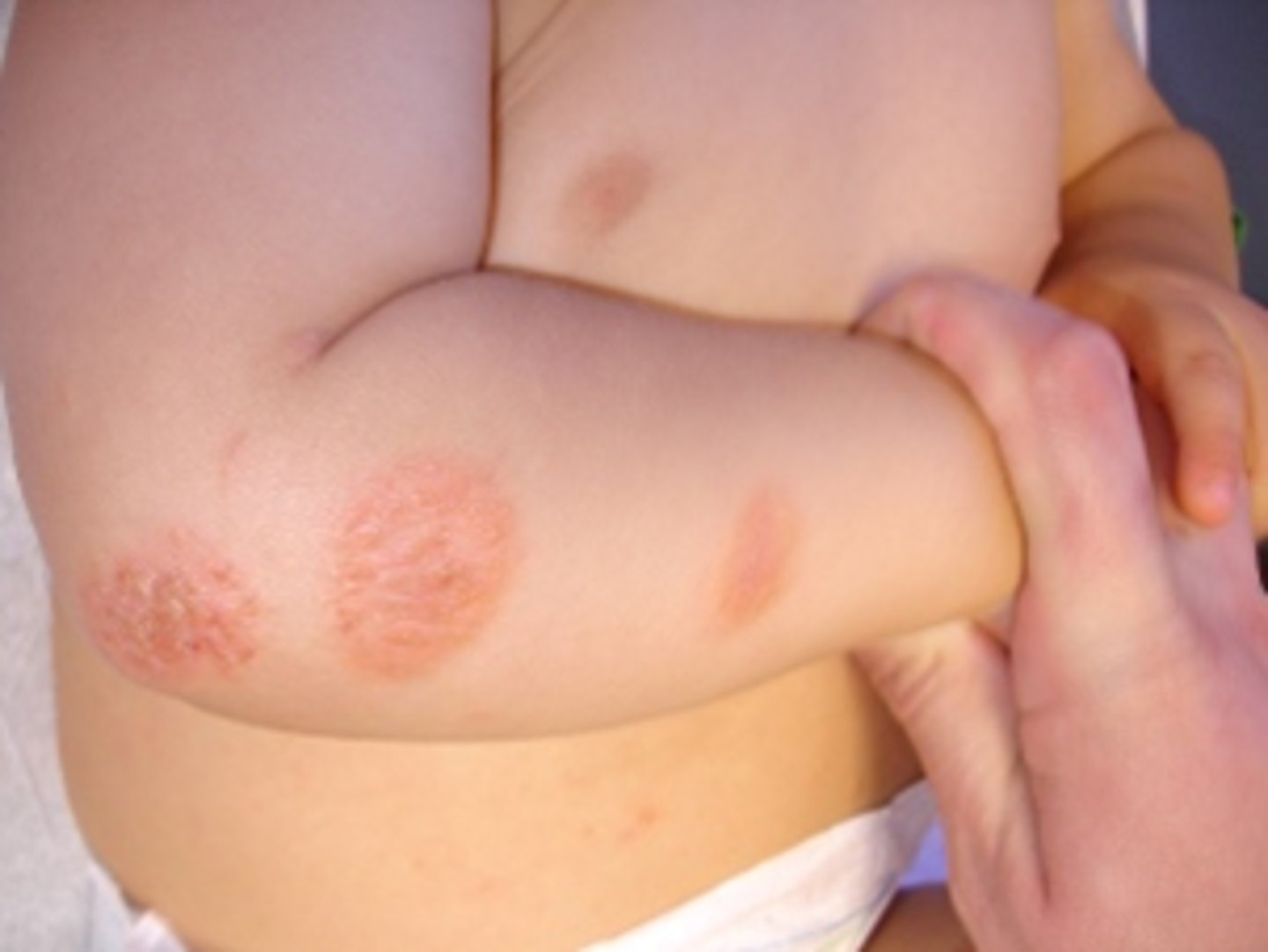 <p>nummular (discoid) eczema</p>