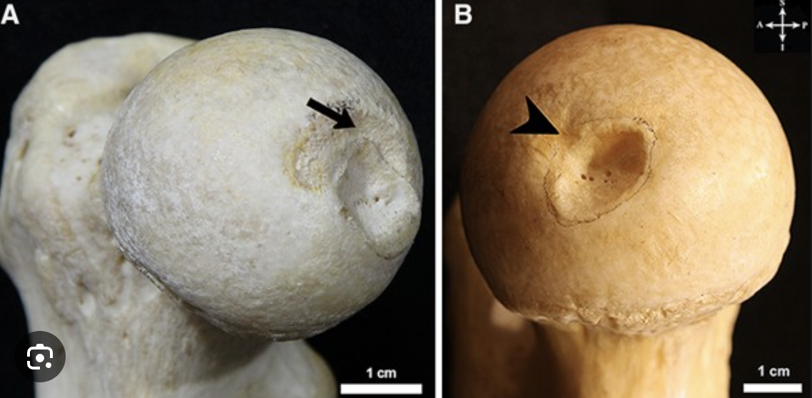 <p>the divet on the medial side of the head</p>