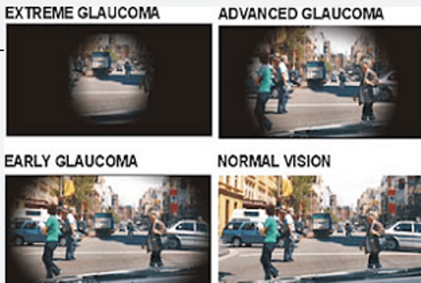 <p>increased intraocular pressure, loss of peripheral vision, disc cupping</p>