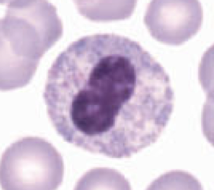 <p>Identify the form of Pelger Huet anomaly according the the following characteristics:</p><ul><li><p>Nucleus is round or oval</p></li><li><p>No segmentation</p></li></ul><p></p>