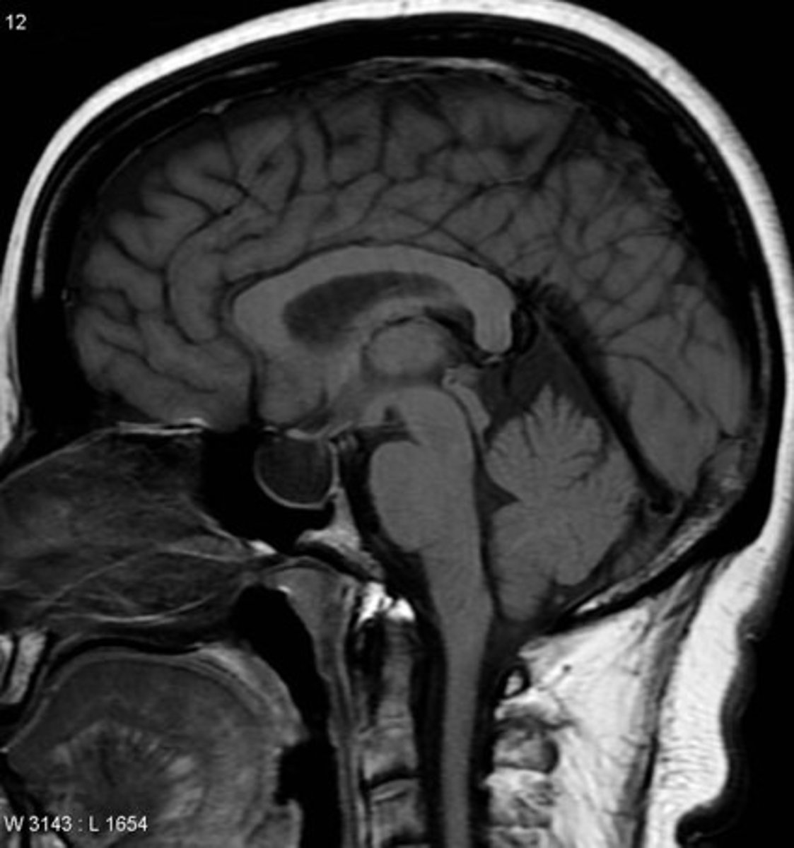 <p>Enlargement of sella turcica + filling w/ CSF; can compress pituitary, but often patients are asymptomatic</p>